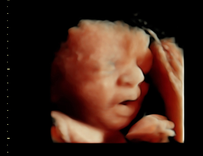3D ultrasound image at 31 weeks